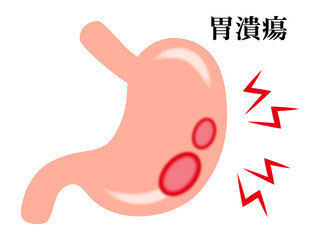 胃潰瘍の胃腸のイラスト素材