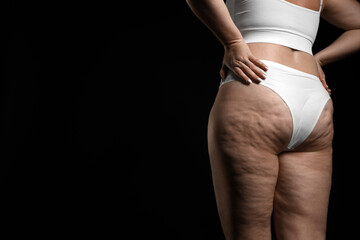 Fototapeta premium Woman with cellulite on black background, closeup. Space for text