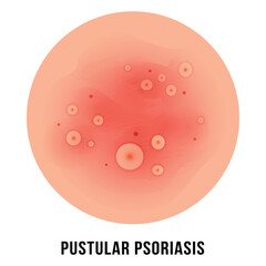 Detailed illustration of skin condition effects at pustular psoriasis