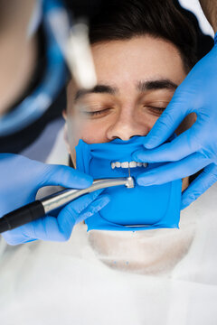 Cofferdam applying in dental treatment. Doctor uses dental drill and cofferdam to prepare the teeth for veneers installation.