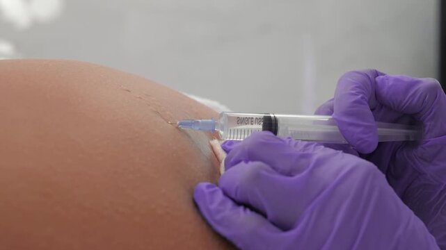 Procedure for removing stretch marks on the skin with injections in a cosmetic clinic. Aesthetic procedure for removing wrinkles on the buttocks with a syringe, performed by a professional