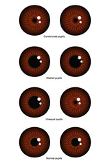 Unequal, Constricted, Dilated and normal pupils eye diseases ophthalmology