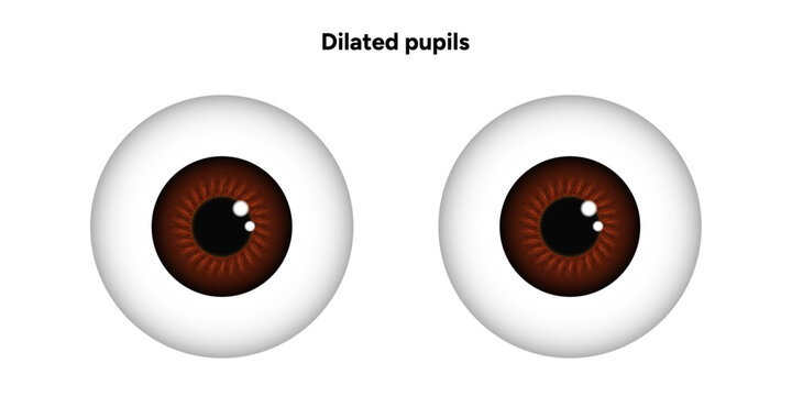 Dilated pupils eye diseases ophthalmology