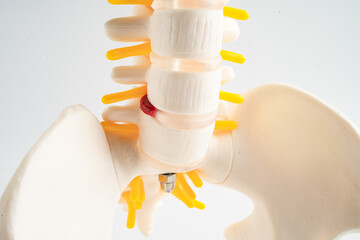 Lumbar spine displaced herniated disc fragment, spinal nerve and bone. Model for treatment medical in the orthopedic department.