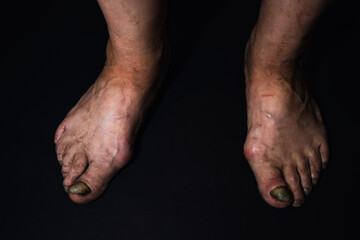 Fototapeta premium A close-up toenail suffering from onycholysis, characterized by its separation from the nail bed.