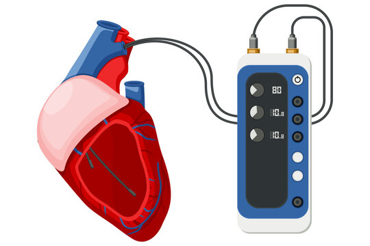 Medical equipment, pacemakers cardiac external temporary permanent system used to pace the heart using electrical impulses. Flat design
