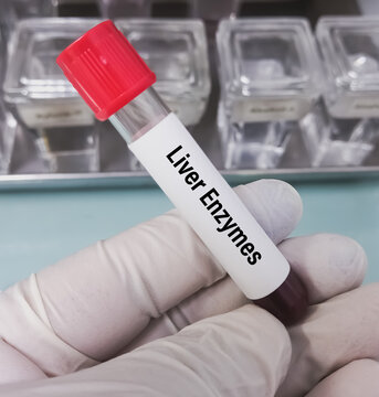 Blood sample for Liver enzyme ( ALP) test. Fatty liver disease test, LFT, Medical concept. FIB-4 or APRI, Gamma GT.