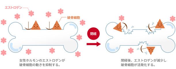女性ホルモンのエストロゲンと骨粗鬆症の関係