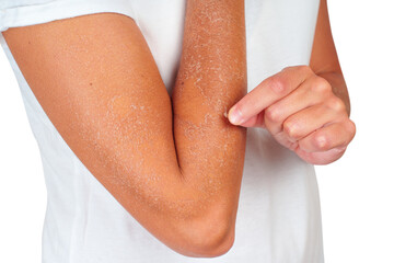 Dry Skin Condition on Arm with Visible Flaking