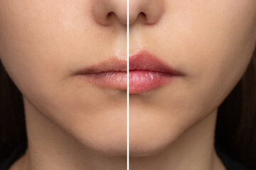 A young woman's lips before and after augmentation, front view. Comparison of thin, ugly lips and...