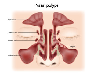 Nasal polyps (NP) Noncancerous growths on the lining of the nose or sinuses. Otorhinolaryngology