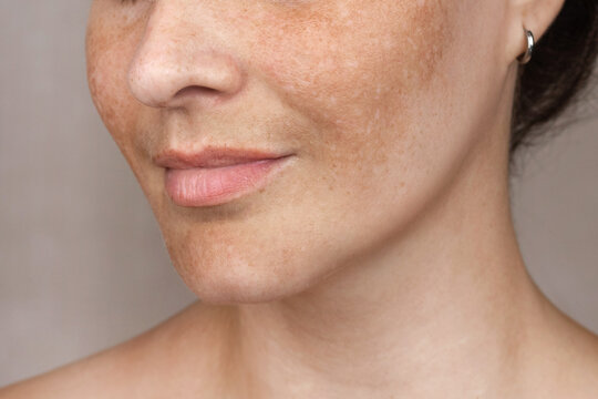 Close up caucasian woman's face with freckles or age spots photo. Age spots on the face melasma