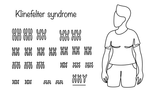Klinefelter syndrome