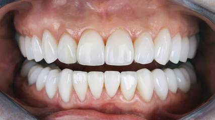 all teeth covered with veneers on the upper and lower jaw