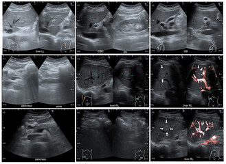 Ultrasound abdomen image of human liver and gallbladder