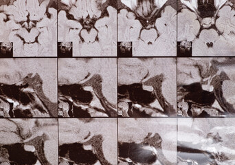 Magnetic resonance imaging of the head of a healthy person, image of the pituitary gland.