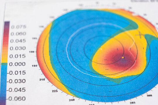 Results of the examination of the thickness and curvature of the cornea in a patient with keratoconus.
