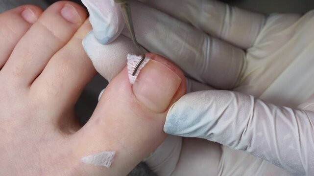Medical pedicure, podiatrist doing tamponade to a deformed toenail