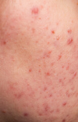 Skin texture background. Closeup acne pimple. Treatment for skin. Problem skincare. Pimples, acne,...