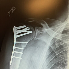 Humerus ORIF