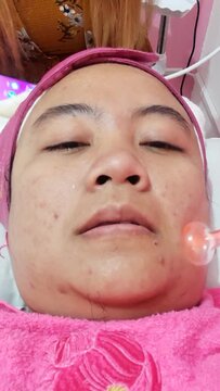 Acne treatment on Asian Woman with facial darsonval therapy procedure in beauty clinic