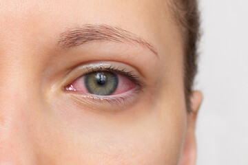 Close up of woman face with red eye. Swollen eyelids, irritation and itching of eyes caused by...