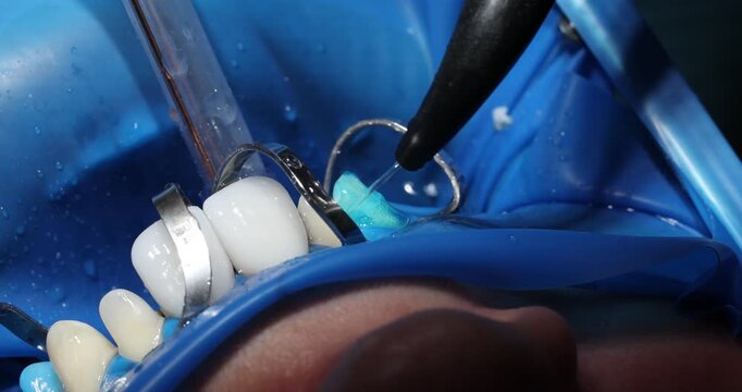 Dentist applies veneers to patient teeth with attention to detail. Doctor makes sure correct adhering enhancing patient smile in hospital