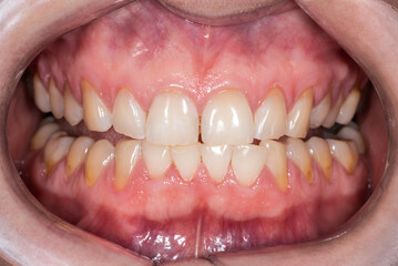 Wedge-shaped defects in human permanent teeth. Gum recession.