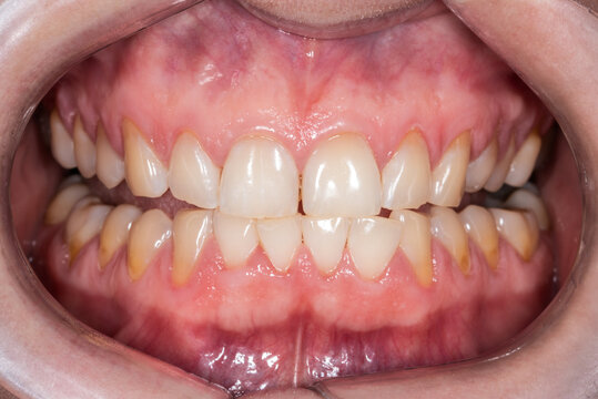 Wedge-shaped defects in human permanent teeth. Gum recession.