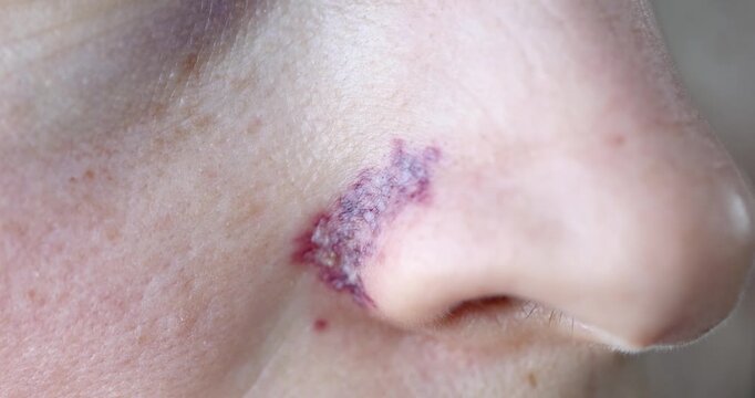 Removal of blood vessels on wings of nose with laser. Skin red redness concept