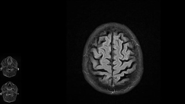 Magnetic resonance imaging of the brain. MRI of the brain. Medical examination of the human brain. Coronal brain MRI for diagnosis of neurological disorders