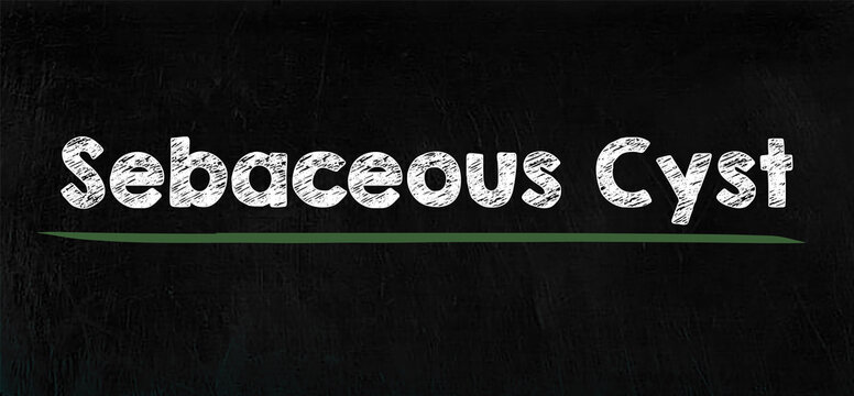 Sebaceous Cyst text chalk design