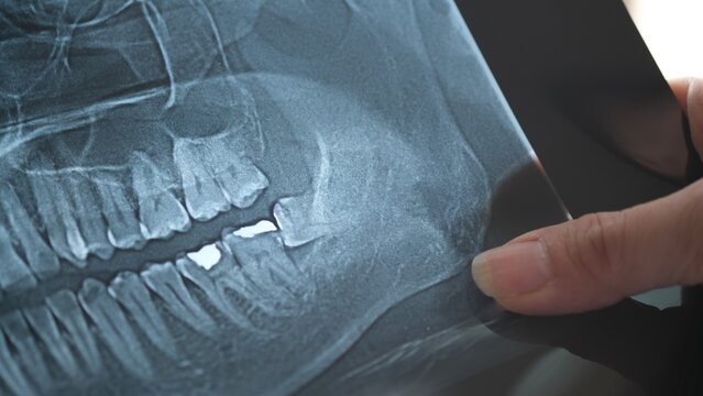 Panoramic x-ray image of teeth and mouth with wisdom teeth.