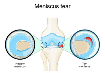 Meniscal tear. Knee anatomy. Close-up of Torn meniscus