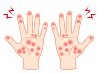 手荒れと手湿疹で赤くなった両手のイラスト素材