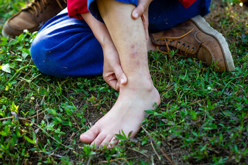 Women feet that are bitten by insects Disease prevention concepts