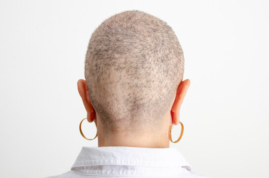 Chemotherapy&rsquo;s Impact on Hair: Back of Woman's Head Showing Baldness 40 Days into Treatment
