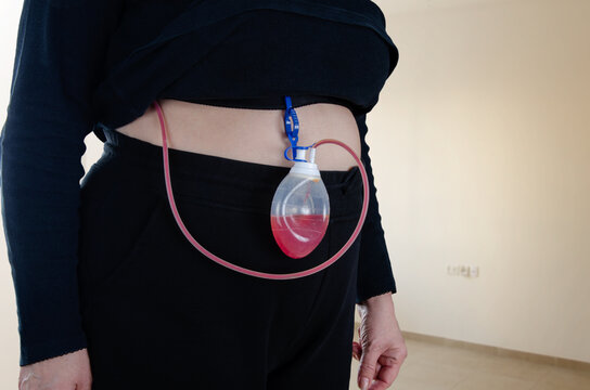 Understanding Post-Surgical Drains: Woman&rsquo;s Experience with Drainage System After Lumpectomy
