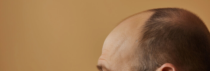 Fototapeta premium Baldness concept. Man with receding hairline on beige background, closeup
