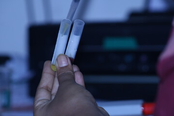 Close up of hand with holding test tube with blood sample in laboratory. Blood sample for amylase...