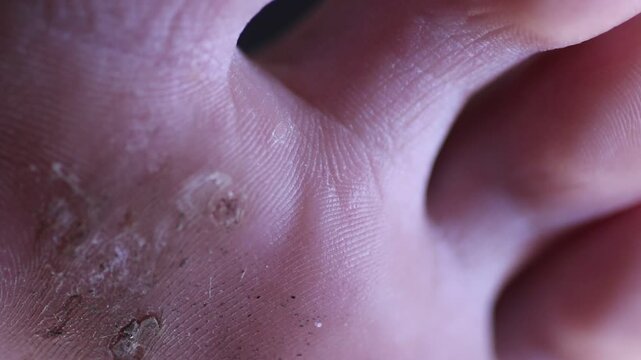 warts or fungus on a girls foot extreme macro 
