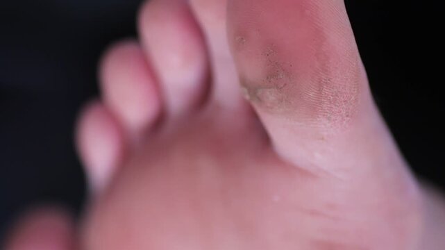 warts or fungus on a girls foot extreme macro 