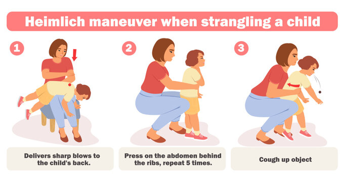 Child help with choking infographic poster vector illustration. First aid CPR emergency help for kids with blocked swallow and breath due to food obstruction