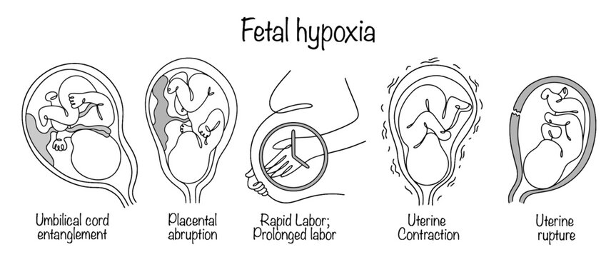 Fetal hypoxia