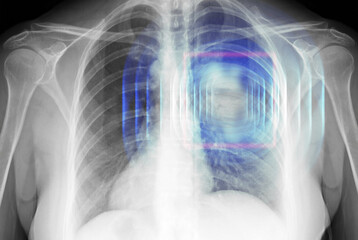 X-ray of human cancer lungs