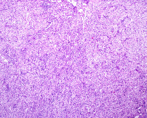 Human kidney. Hypernephroma