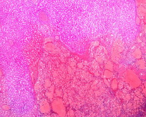 Human liver haemangioma