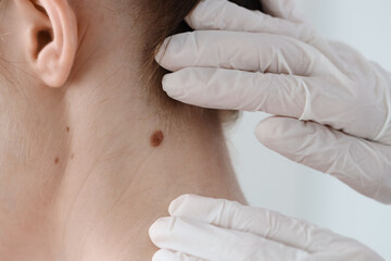 Fototapeta premium Doctor examining woman's mole in clinic, closeup