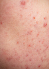 Fototapeta premium Skin texture background. Closeup acne pimple. Treatment for skin. Problem skincare. Pimples, acne, pores, scars. Natural skin. Skin care concept. Acne treatment. Pimples on face. Acne and pimple on