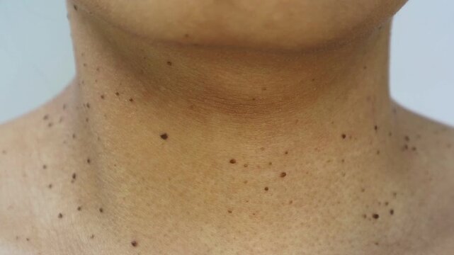Close up the skin tags on woman's neck. Acrochordon. Health care concept. Woman showing her neck's skin with skin tag.